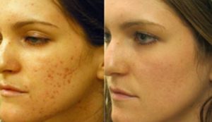 Microneedling Your Acne Away img 1