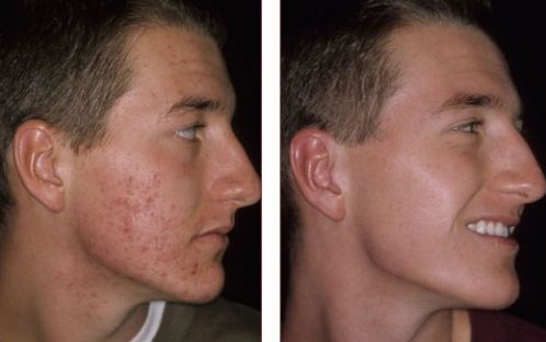 Microneedling Your Acne Away img 2