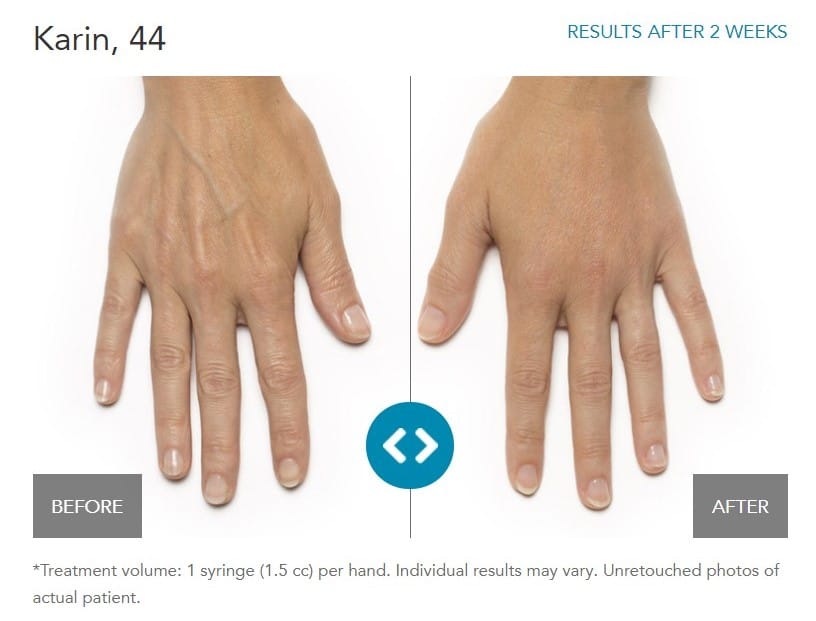 Take Back The Hands Of Time With Our Combination Treatment of Radiesse & a TCA Peel img 1