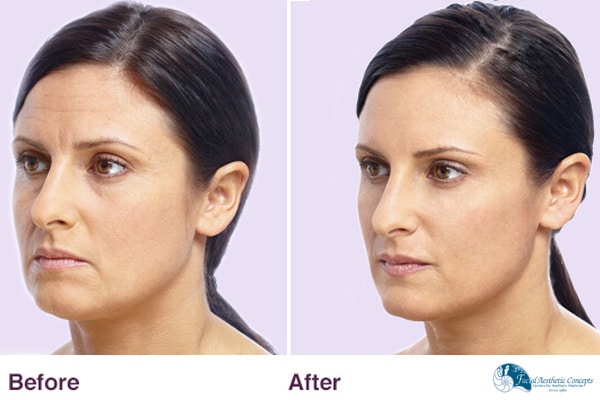 Before And After Botox Dermal Filler Results