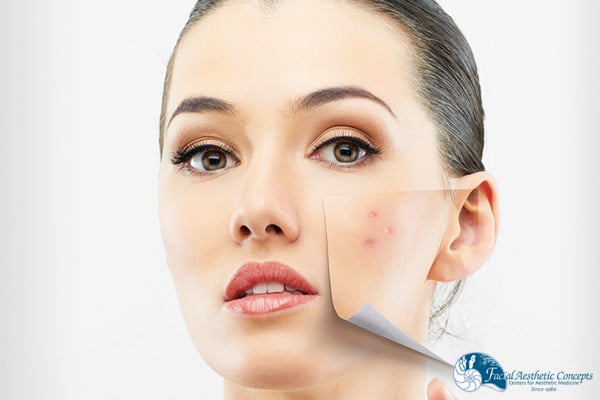 Chemical peel benefits Image - FAC