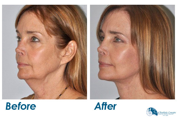 Facelift Surgery Before and After Results