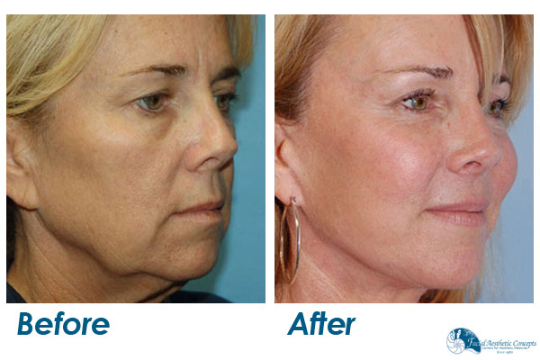 Facelift Surgery Before and After Results