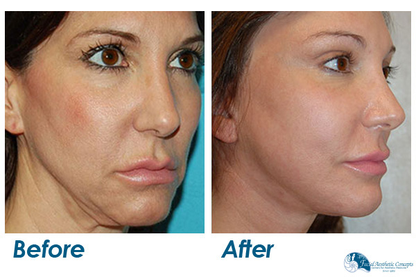 Facelift Surgery Before and After Results