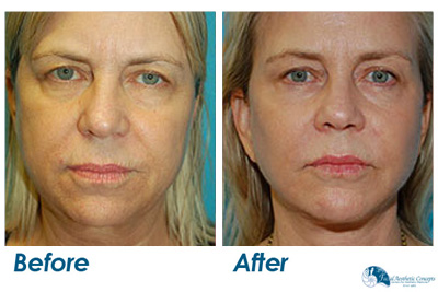 Facelift Surgery Before and After Results