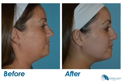 Facelift Surgery Before and After Results