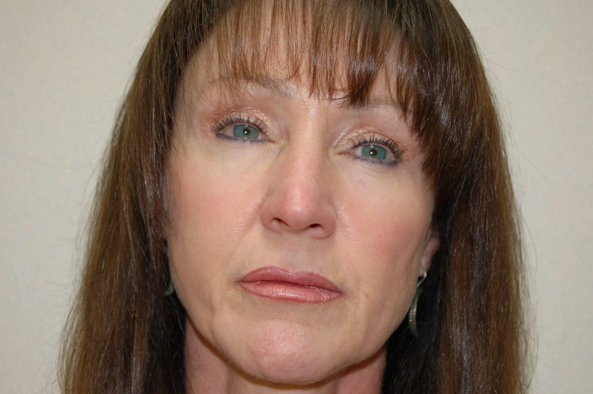 Facial Rejuvenation Patient Photo - Case 3805 - before view-