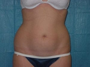 Liposuction in Aliso Viejo Orange County, Ca - Before 2a