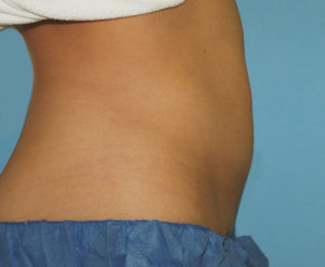 After Coolsculpting Aliso Viejo Orange County