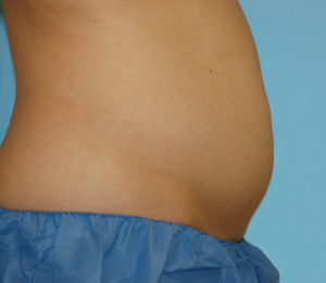 Before Coolsculpting Aliso Viejo Orange County