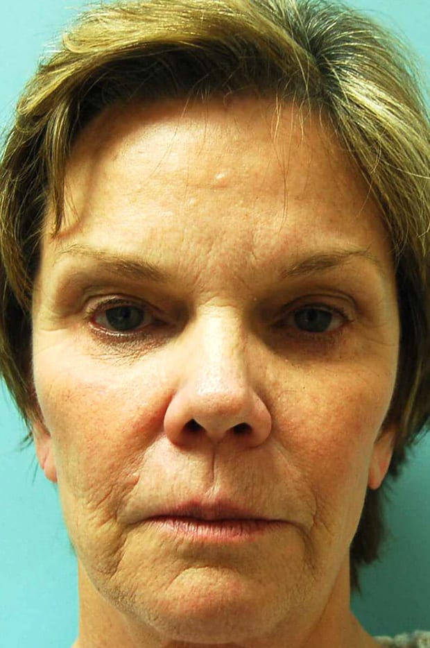 Microlift Patient Photo - Case 3798 - before view-