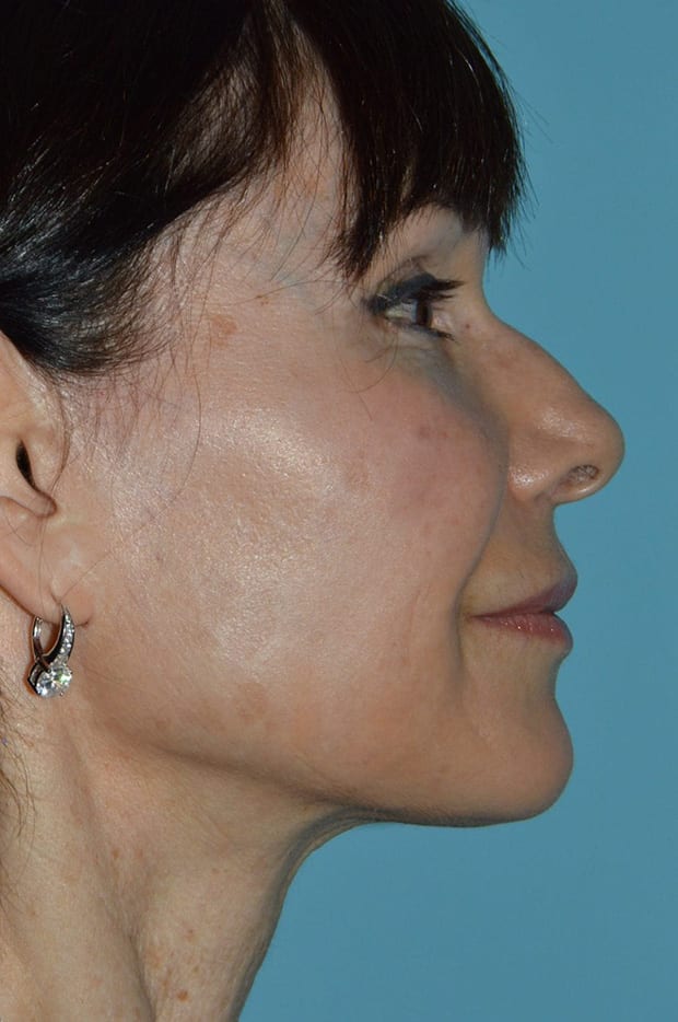 Microlift Patient Photo - Case 3814 - before view-4