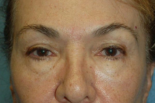 Lower Eyelid Lift/Pinch Patient Photo - Case 3838 - before view-