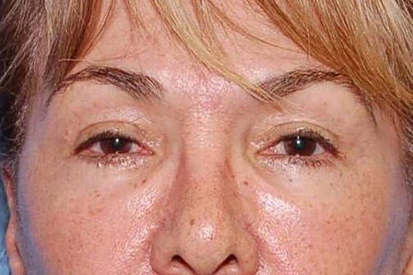 Lower Eyelid Lift/Pinch Patient Photo - Case 3838 - after view