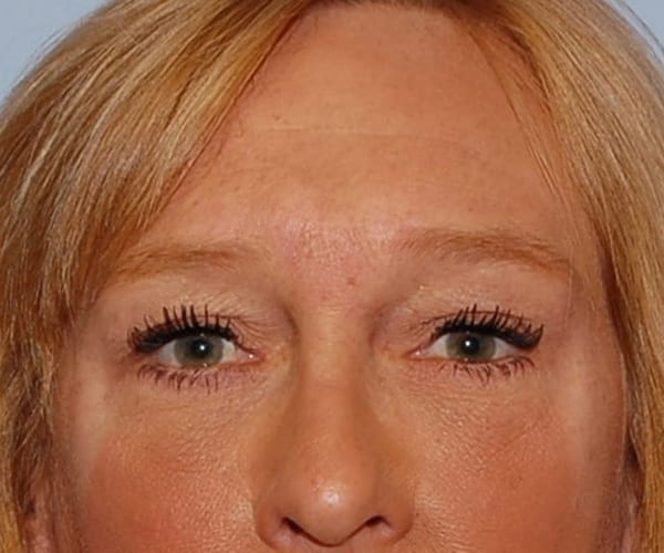 Forehead Lift Patient Photo - Case 3843 - after view