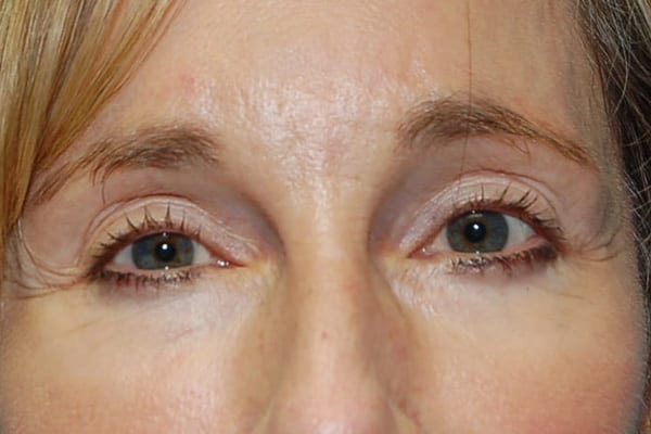 Lower Eyelid Lift/Pinch Patient Photo - Case 3853 - after view