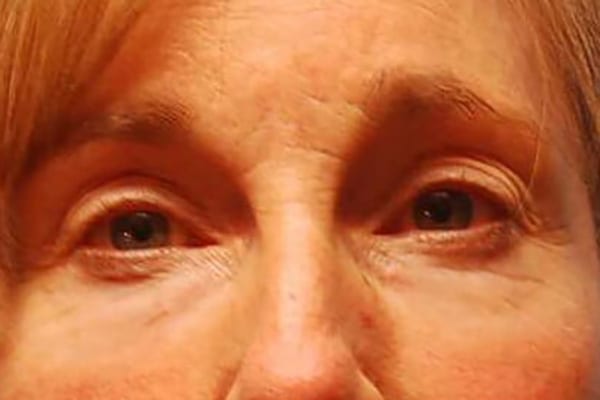 Lower Eyelid Lift/Pinch Patient Photo - Case 3853 - before view-