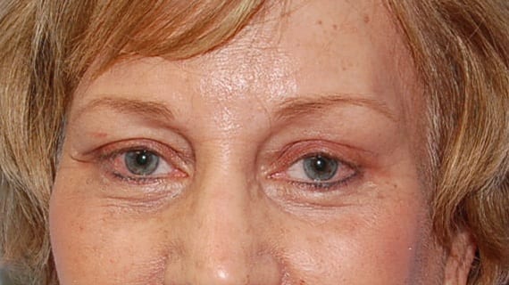 Forehead Lift Patient Photo - Case 3856 - after view