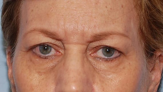 Forehead Lift Patient Photo - Case 3856 - before view-