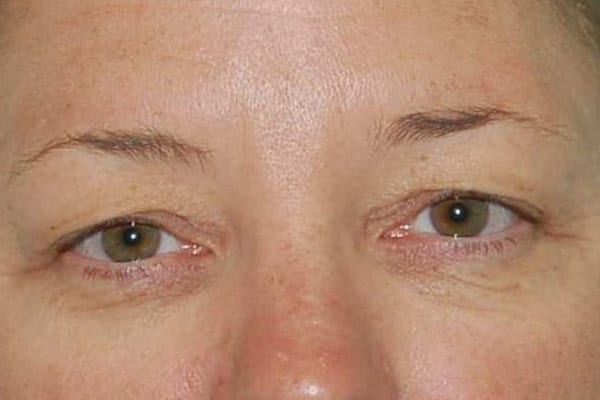 Upper Eyelid Lift - Case 3867 - Before