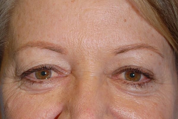 Lower Eyelid Lift/Pinch Patient Photo - Case 3877 - before view-