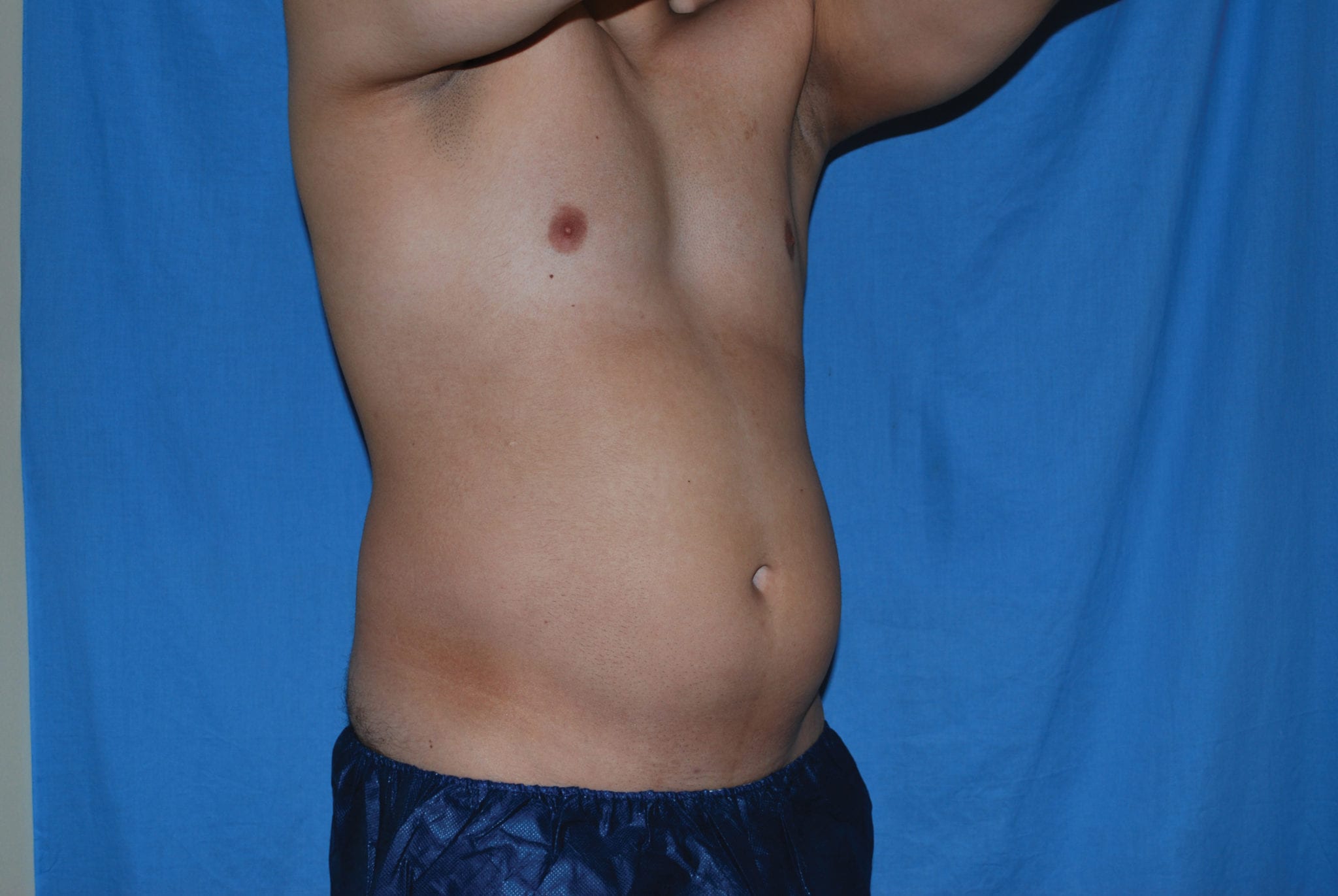 Liposuction Patient Photo - Case 3537 - after view-3