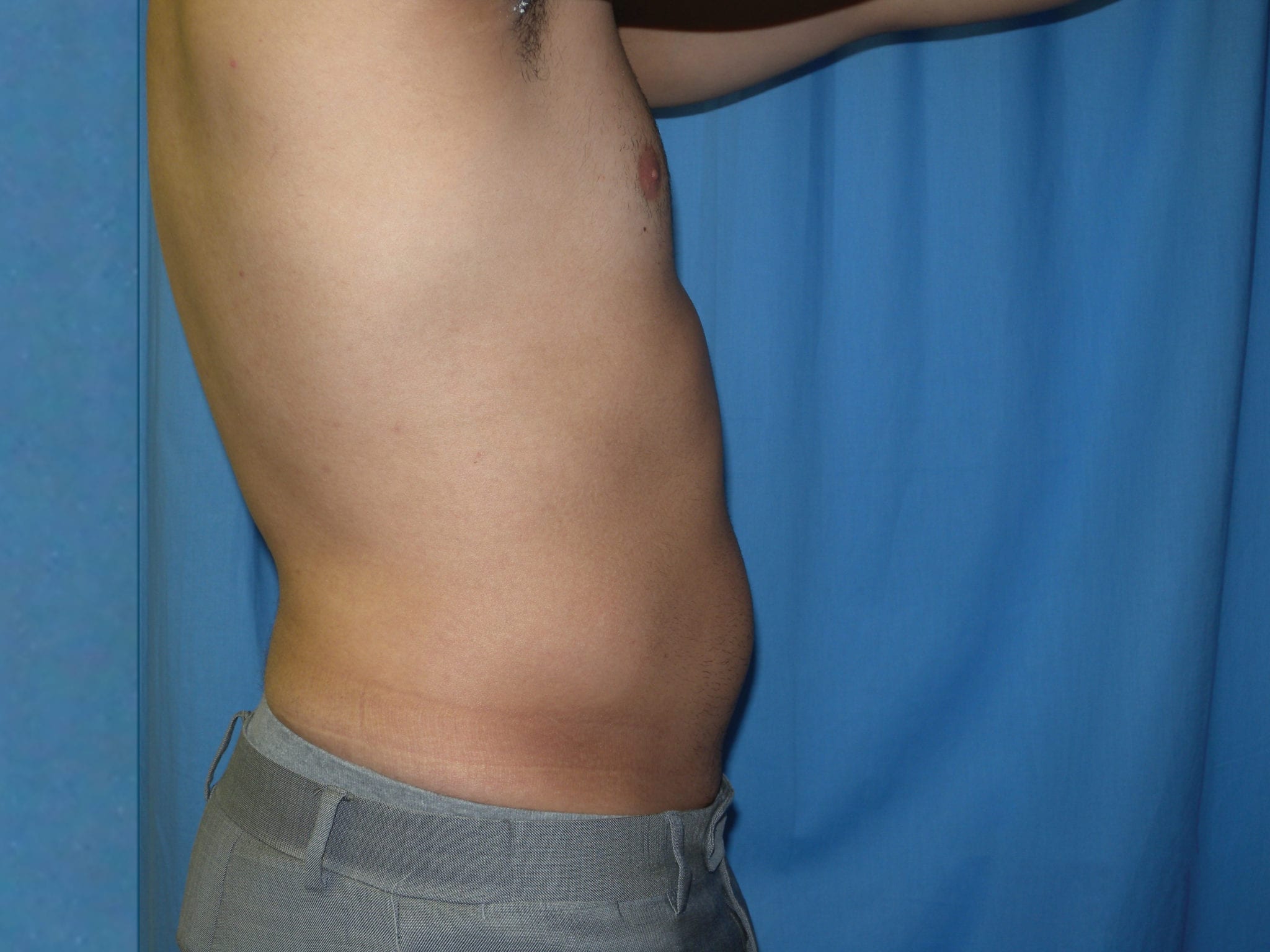 Liposuction Patient Photo - Case 3537 - before view-3