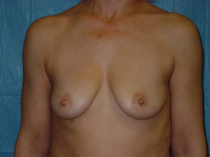 Breast Augmentation & Implants in San Clemente - Before 2a