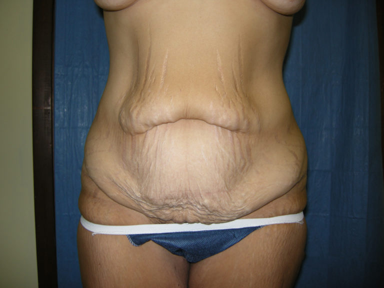 Tummy Tuck - Case 3343 - Before