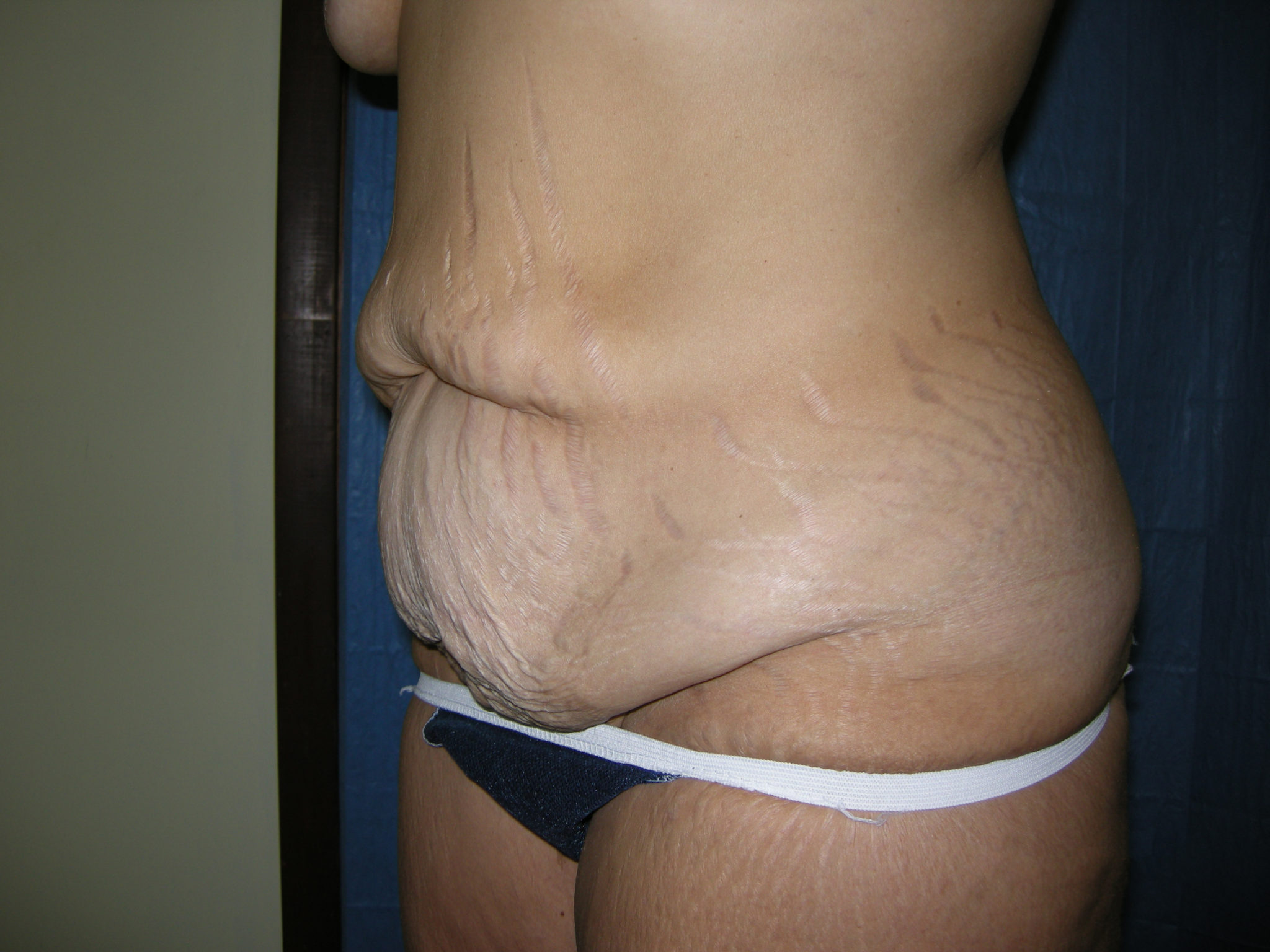 Tummy Tuck Patient Photo - Case 3343 - before view-1