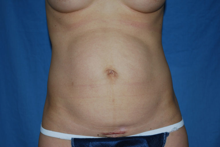 Tummy Tuck - Case 3433 - Before