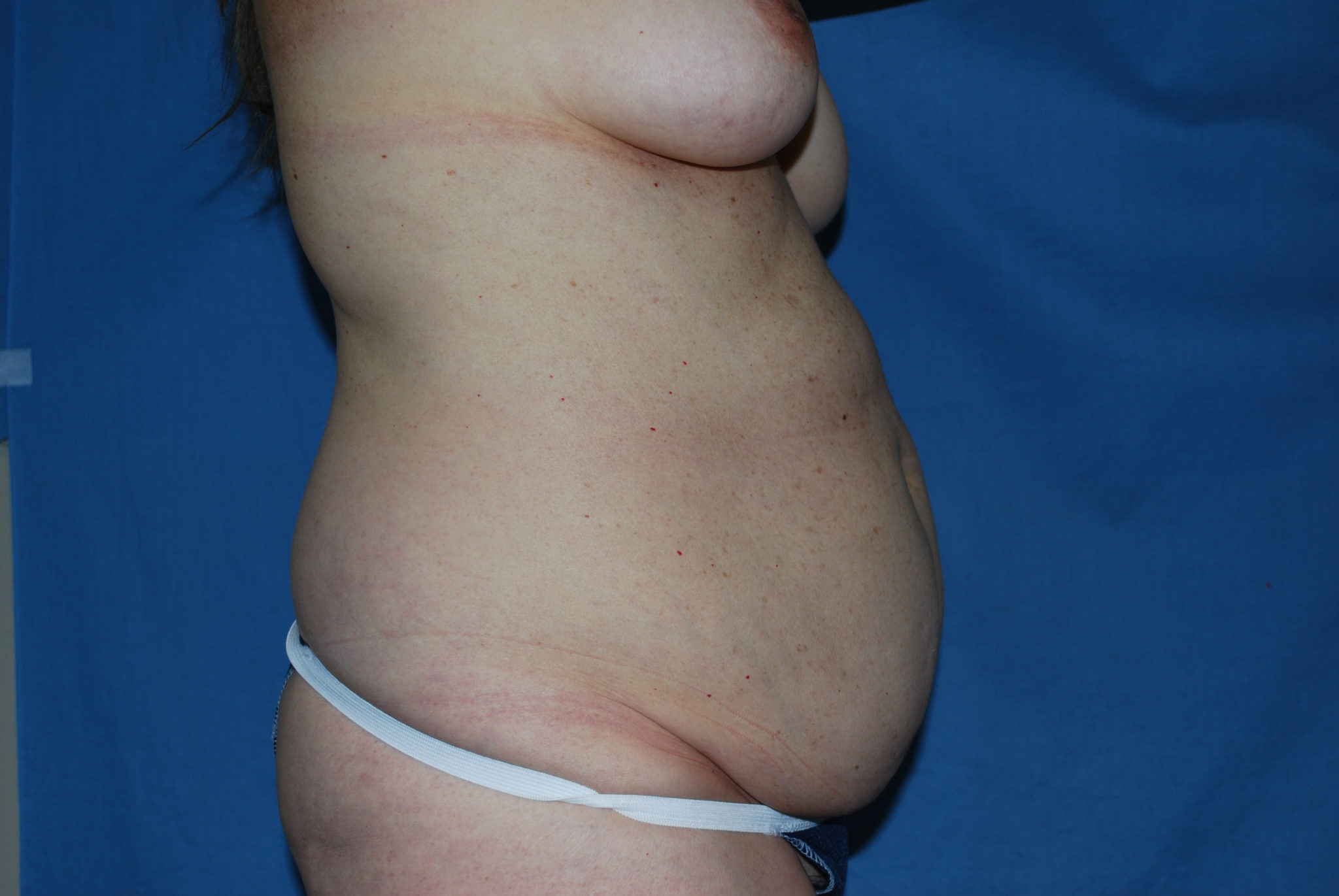 Tummy Tuck Patient Photo - Case 3454 - before view-3