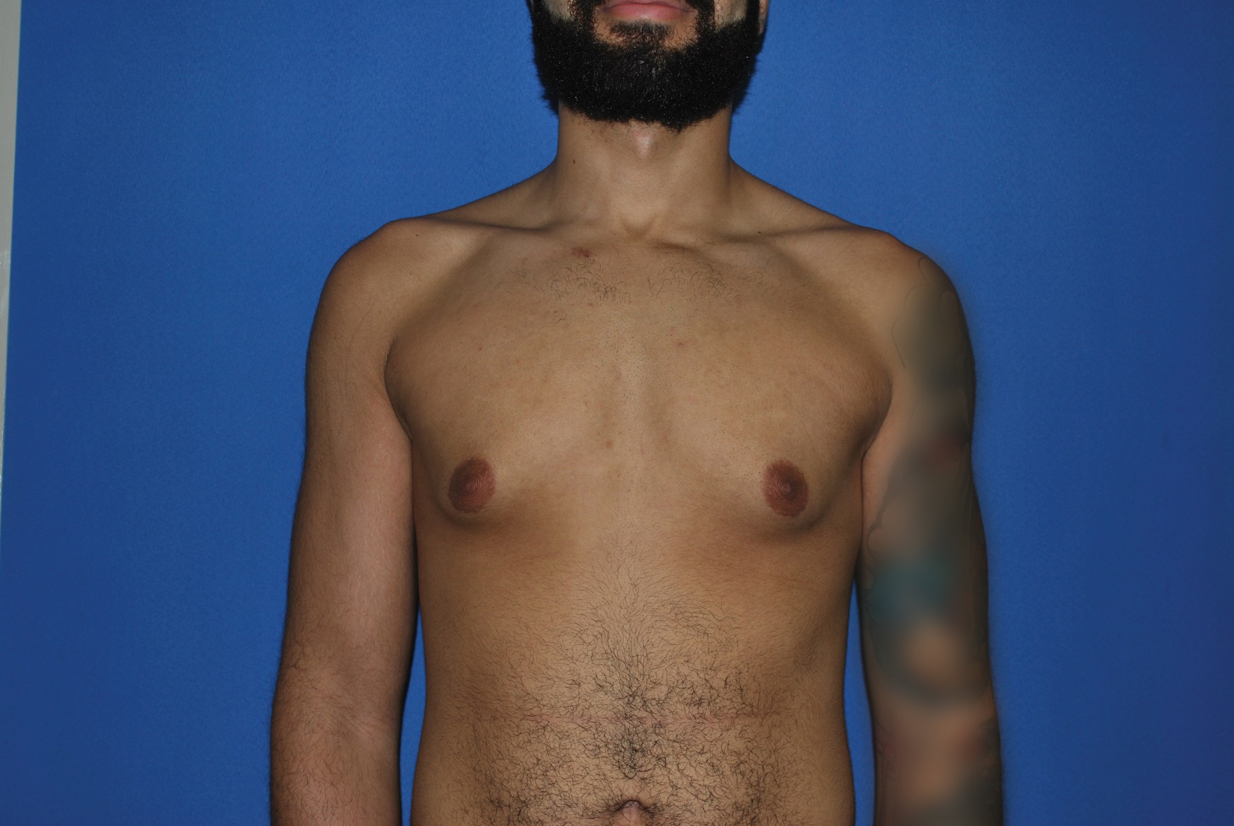 Male Breast Reduction Patient Photo - Case 5035 - before view-