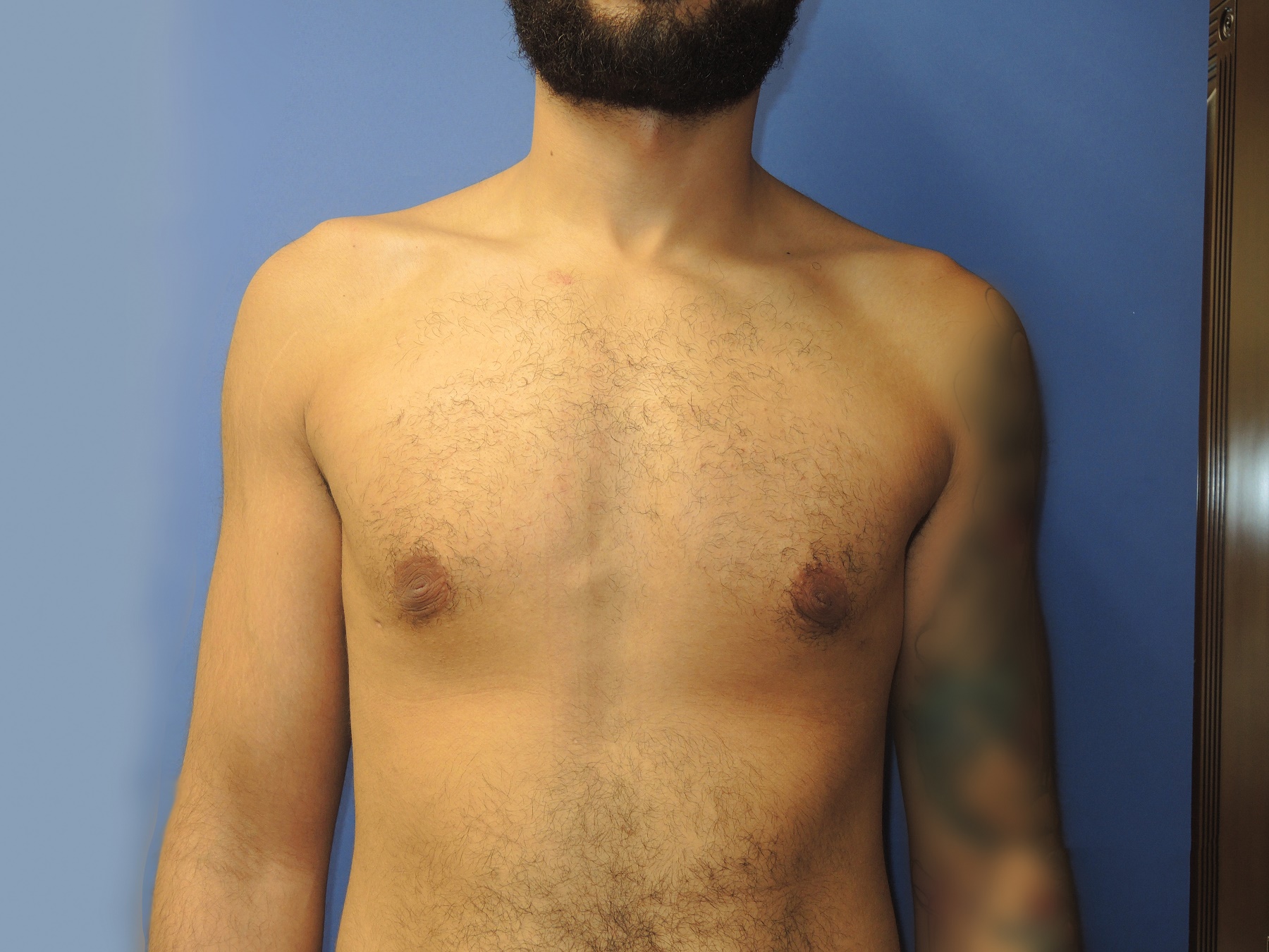 Male Breast Reduction Patient Photo - Case 5035 - after view