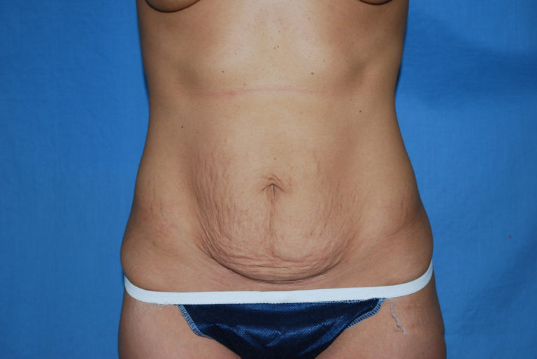 Tummy Tuck - Case 3297 - Before