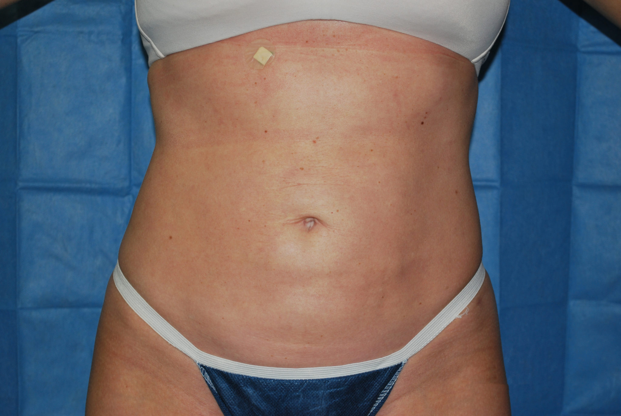 Liposuction Patient Photo - Case 2990 - after view