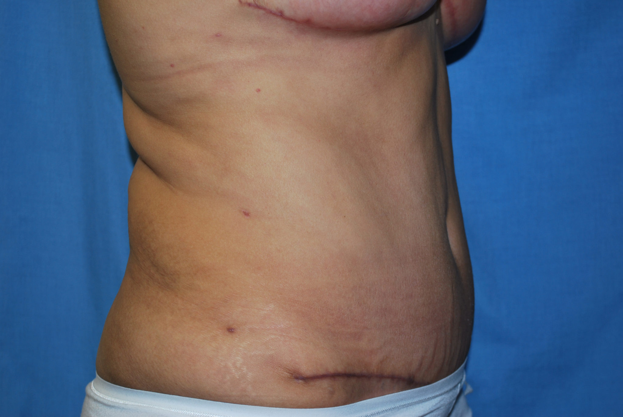 Liposuction Patient Photo - Case 3405 - after view-2