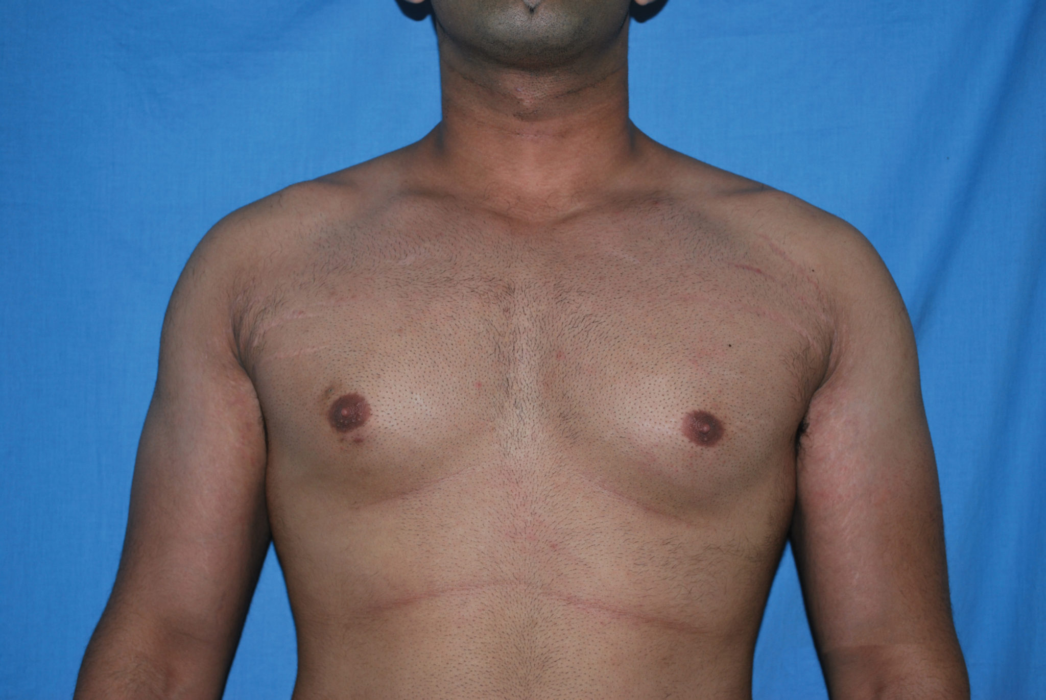 Male Breast Reduction Patient Photo - Case 5042 - before view-