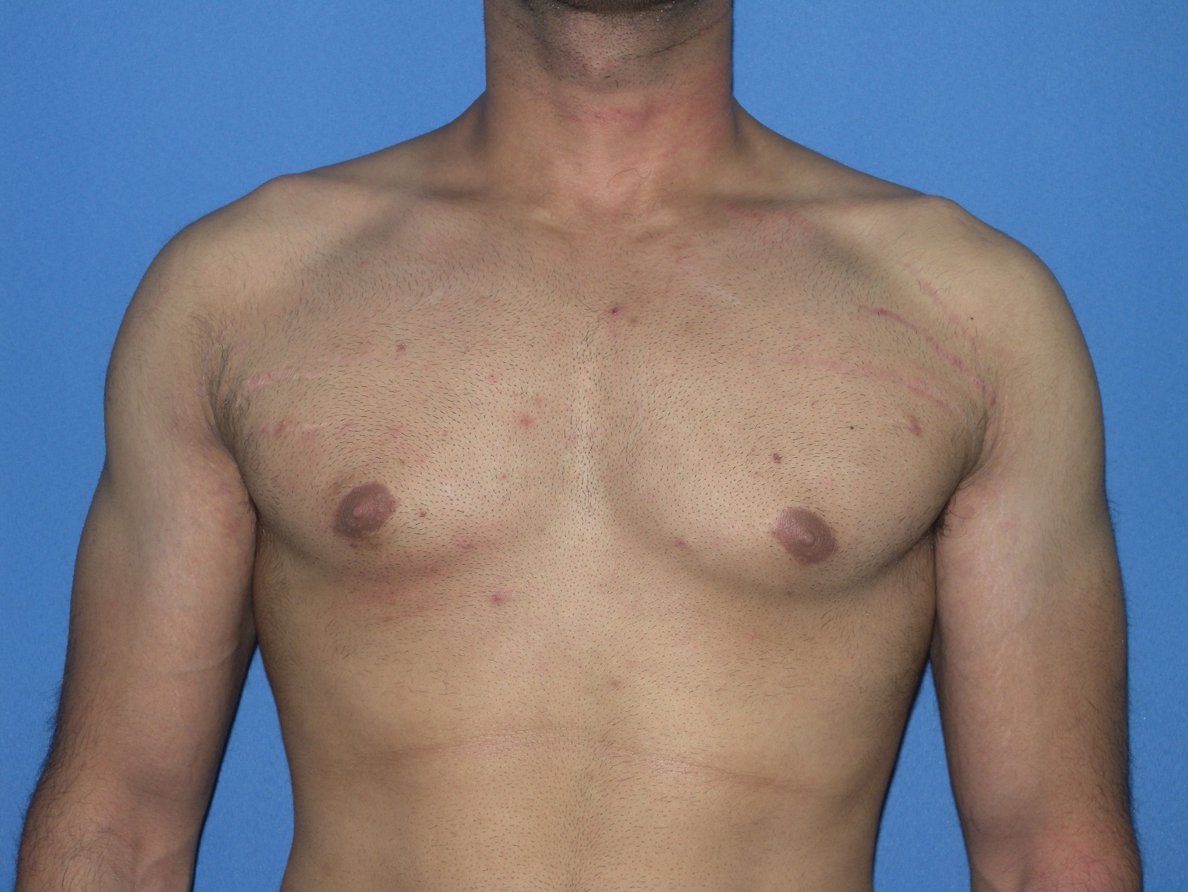 Male Breast Reduction Patient Photo - Case 5042 - after view