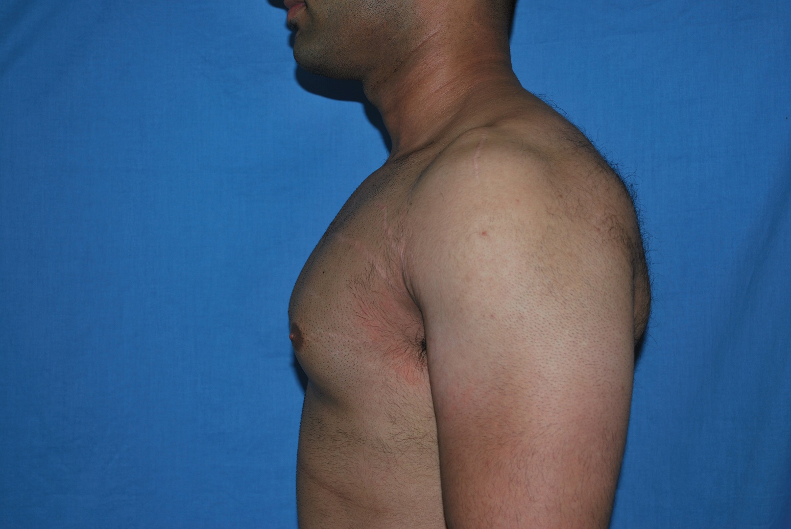 Male Breast Reduction Patient Photo - Case 5042 - before view-3