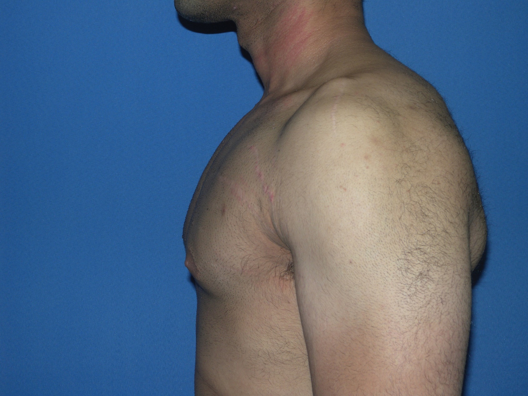 Male Breast Reduction Patient Photo - Case 5042 - after view-3