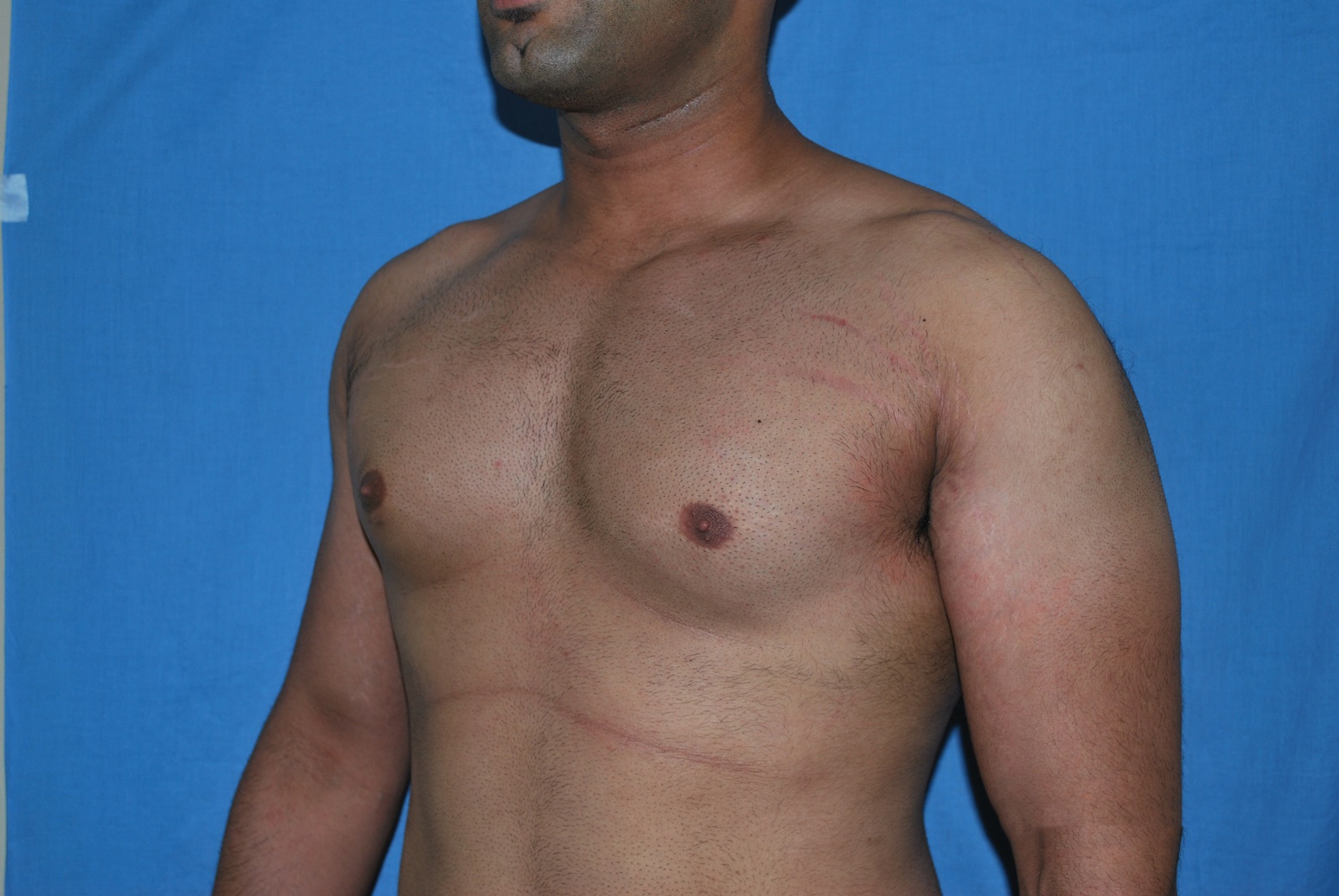 Male Breast Reduction Patient Photo - Case 5042 - before view-2