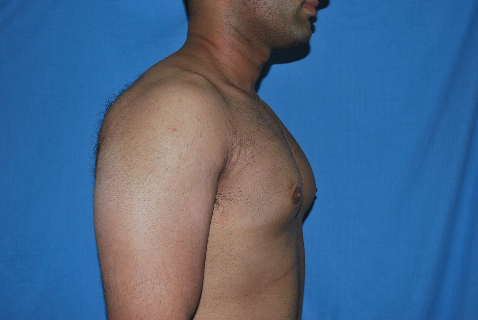 Male Breast Reduction Patient Photo - Case 5042 - before view-1