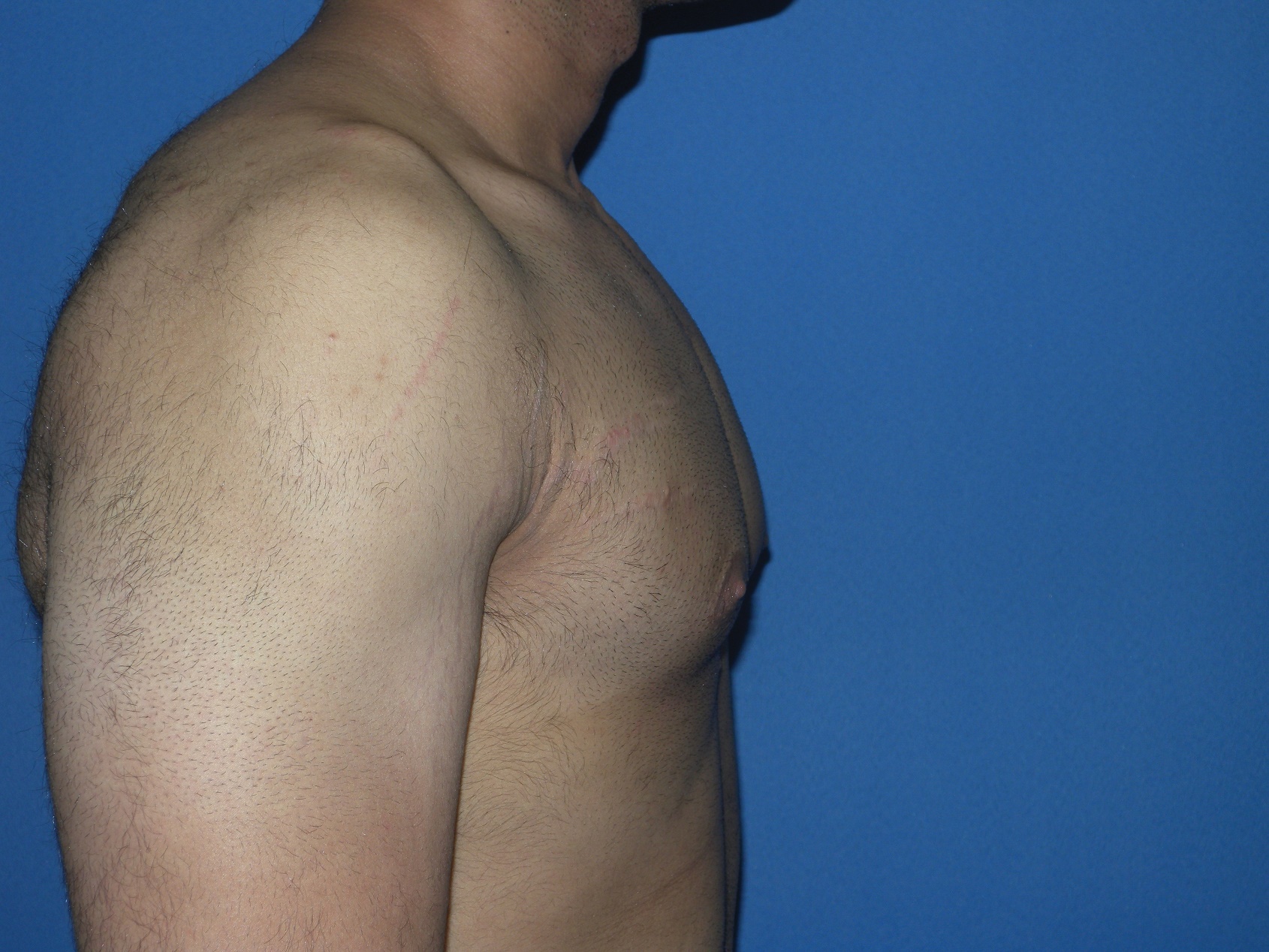 Male Breast Reduction Patient Photo - Case 5042 - after view-1