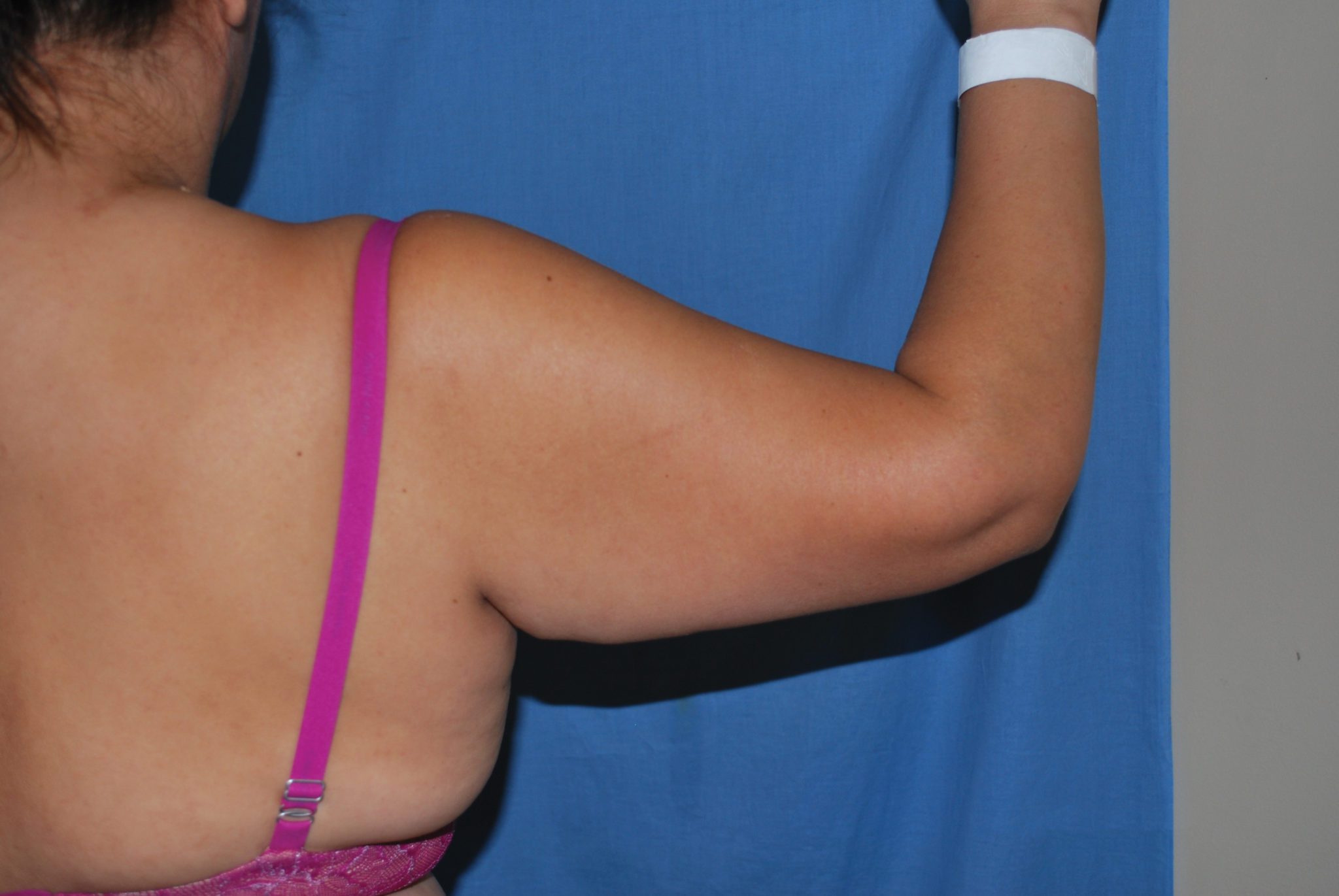 Arm Lift Patient Photo - Case 4228 - before view-