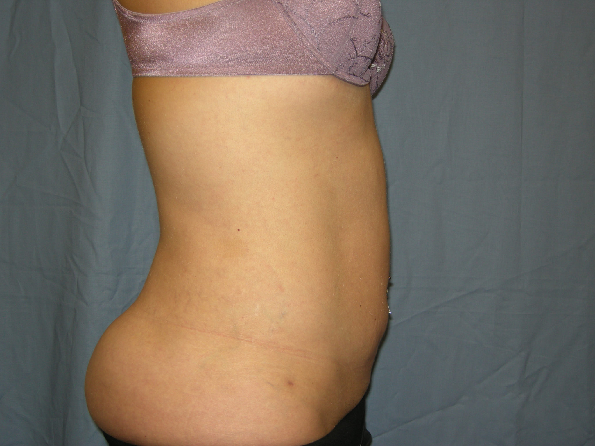 Liposuction Patient Photo - Case 3012 - after view-4