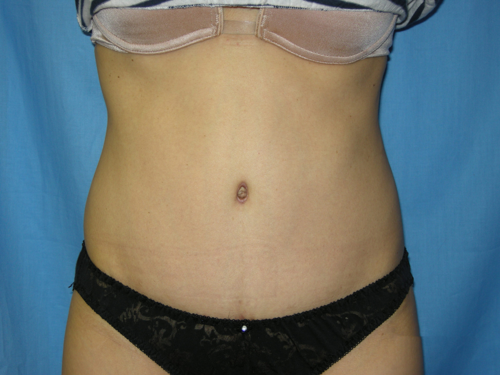 Tummy Tuck Patient Photo - Case 3433 - after view