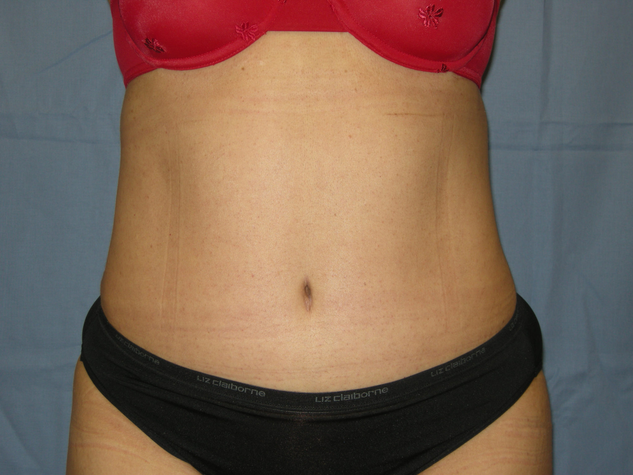 Liposuction Patient Photo - Case 3370 - after view