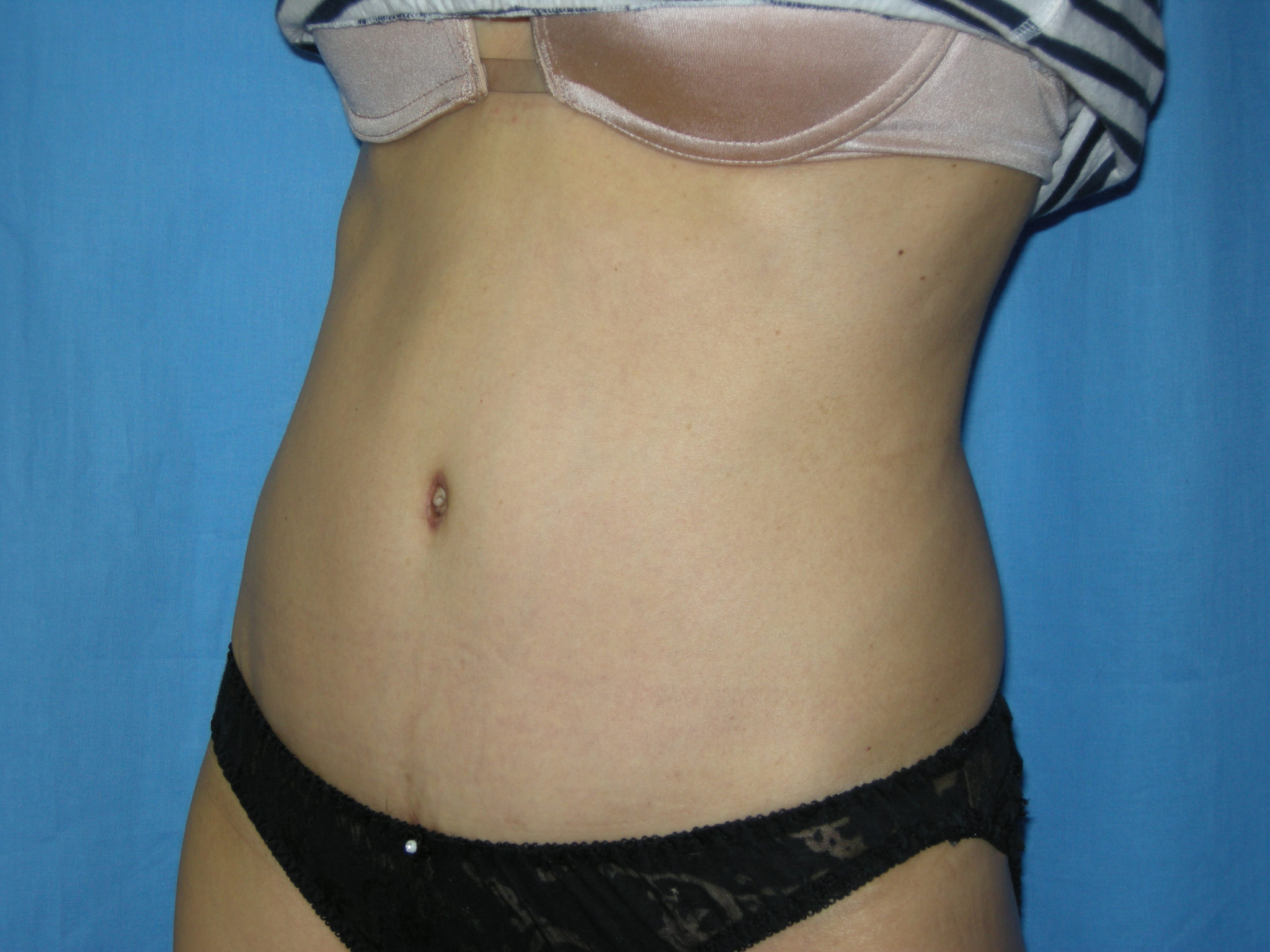 Tummy Tuck Patient Photo - Case 3433 - after view-2