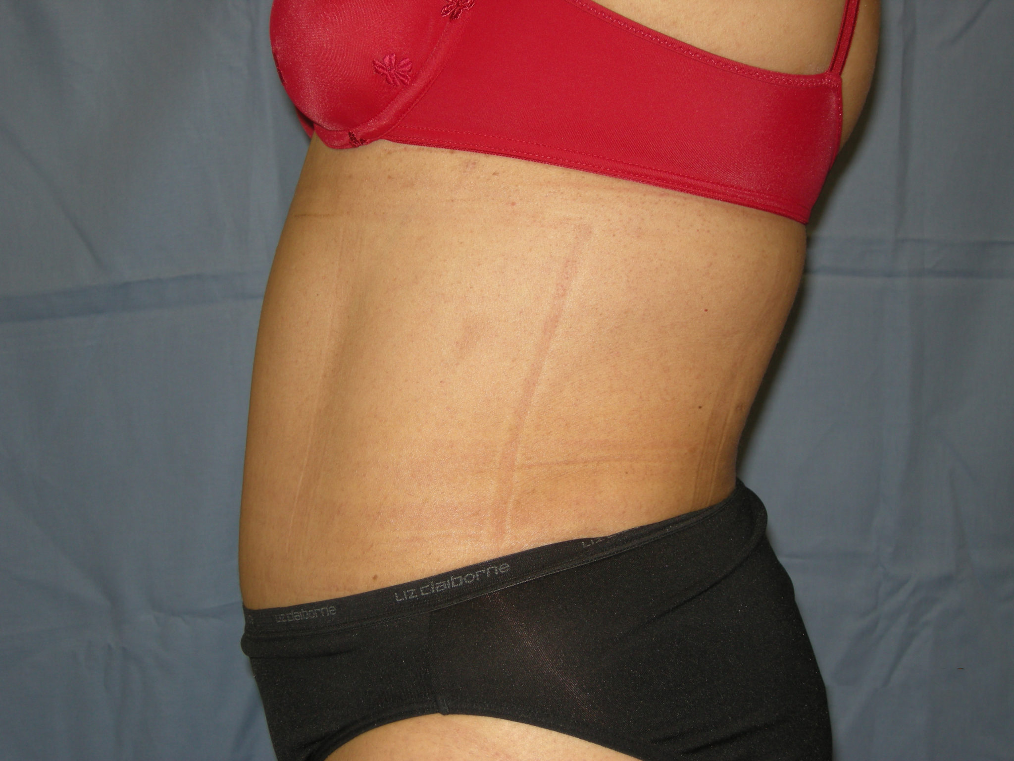 Liposuction Patient Photo - Case 3370 - after view-1